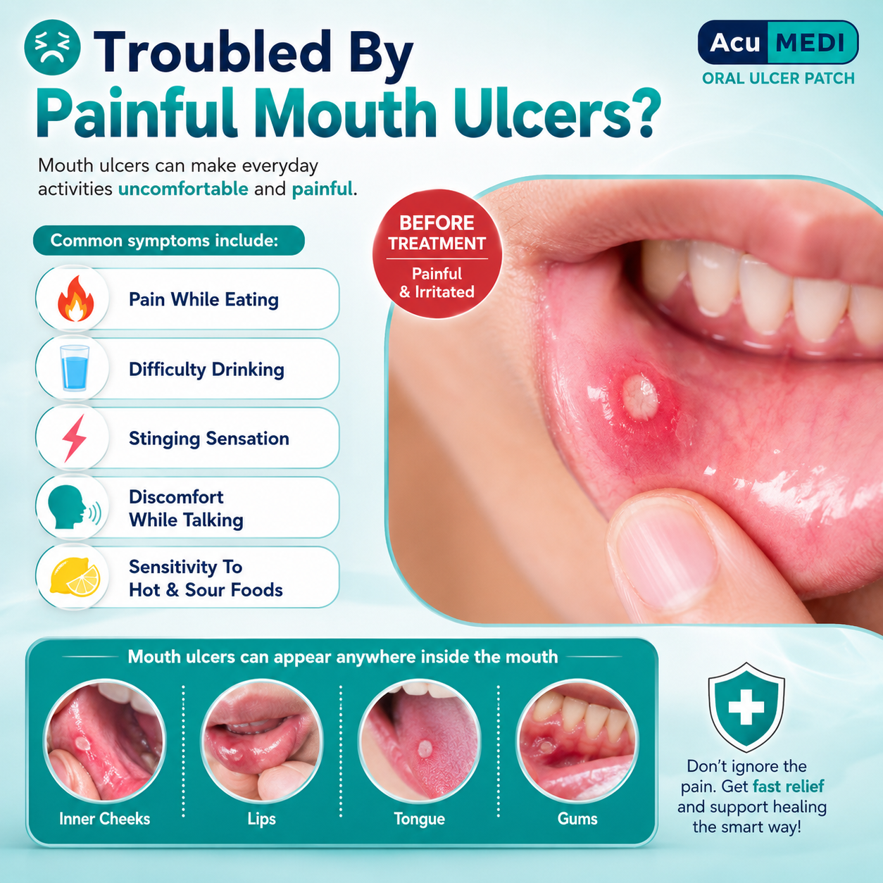 AcuMEDI Oral Ulcer Patch 6pcs | Instant Relief | Non-Steroid | Safe for Kids